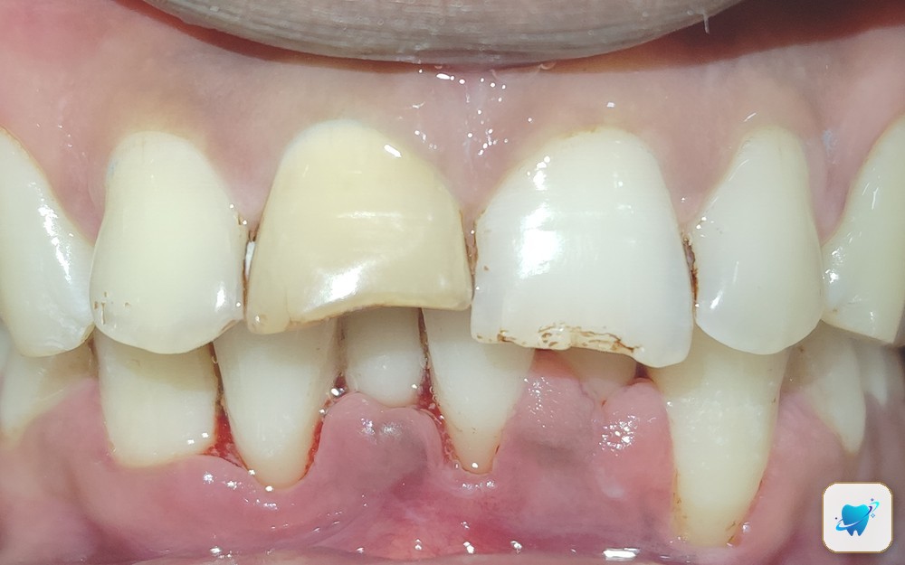 After treatment