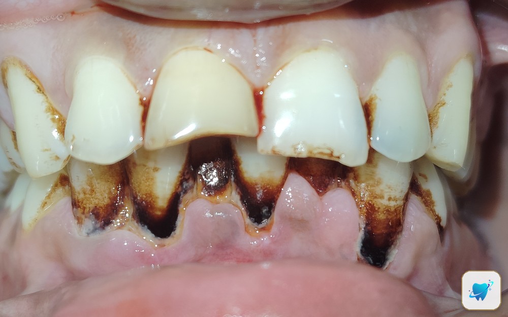 Before treatment